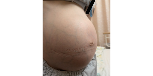 出産前日のお腹。妊娠線ができていないことを示している。